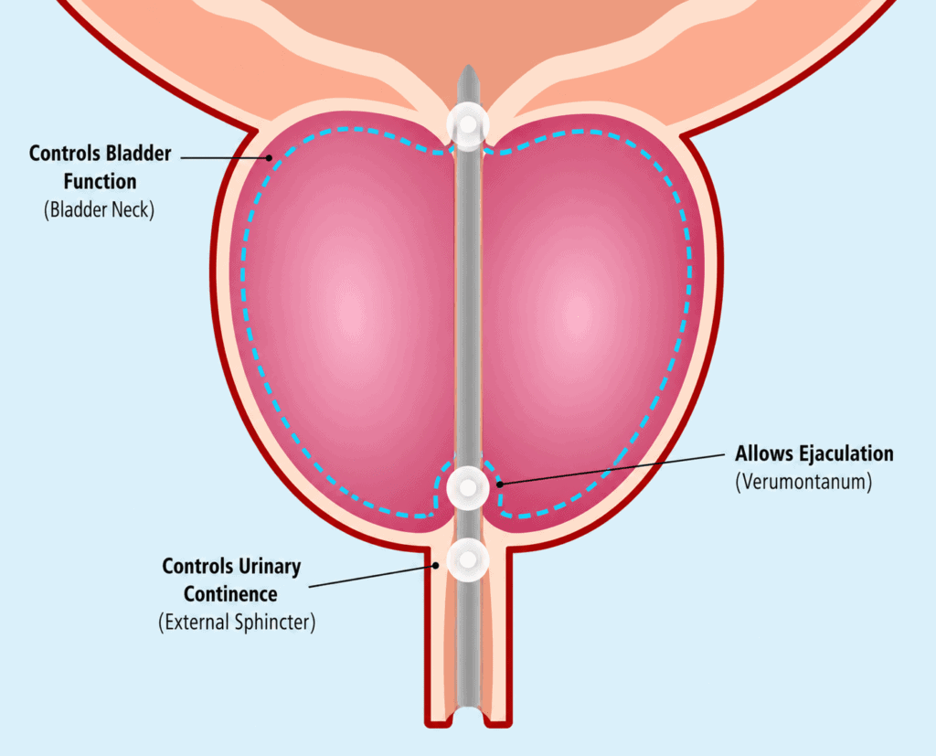 Aquablation Therapy for Enlarged Prostate (BPH)